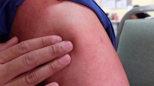 Yağ bezesi ameliyatı oldu 11 yıldır kolunu kullanamıyor