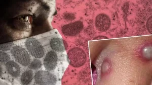 Maymun Çiçeği Virüsü Bir Ülkeye Daha Sıçradı…