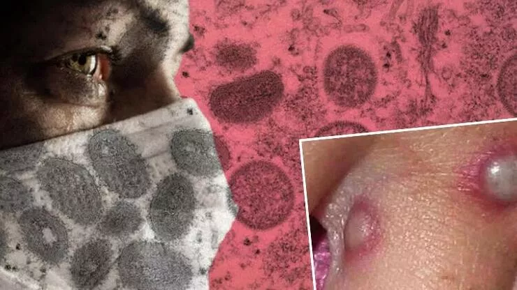 Maymun Çiçeği Virüsü Bir Ülkeye Daha Sıçradı…