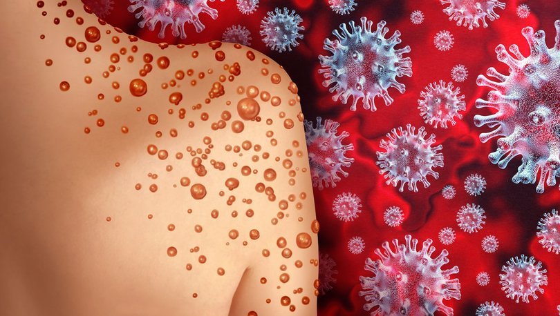 Maymun Çiçeğinde Yeni Tehlike! DSÖ Bir İlk Diyerek Açıkladı