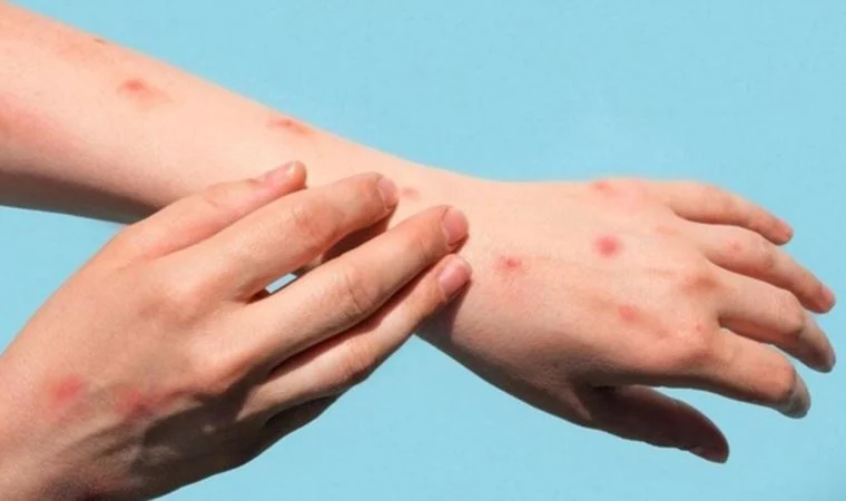 Almanya’da 4 Yaşındaki Çocuğa Maymun Çiçeği Virüsü Bulaştı